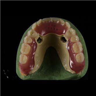 Зубний протез Peek Framework