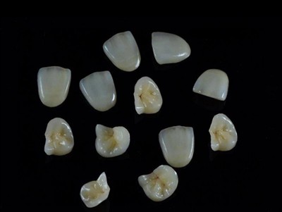 Як вибрати найкращий стоматологічний клей для коронок: останній посібник