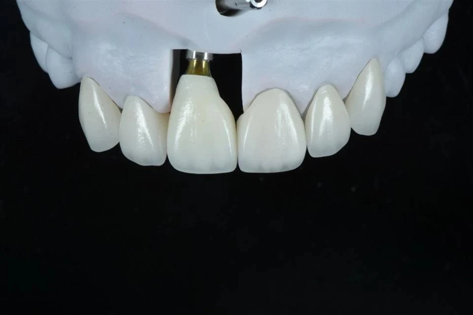Implant Crown Compatible With Major Implant Systems Implant Crown Compatible With Major Implant Systems
