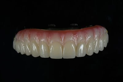 Верхньощелепний All-on-X Zirconia Bridge