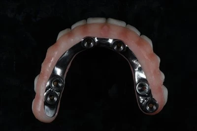 Гвинт-утримується все-на-X Zirconia Bridge
