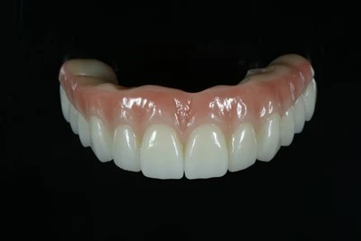 Титановий-посилений-на-X Zirconia Bridge